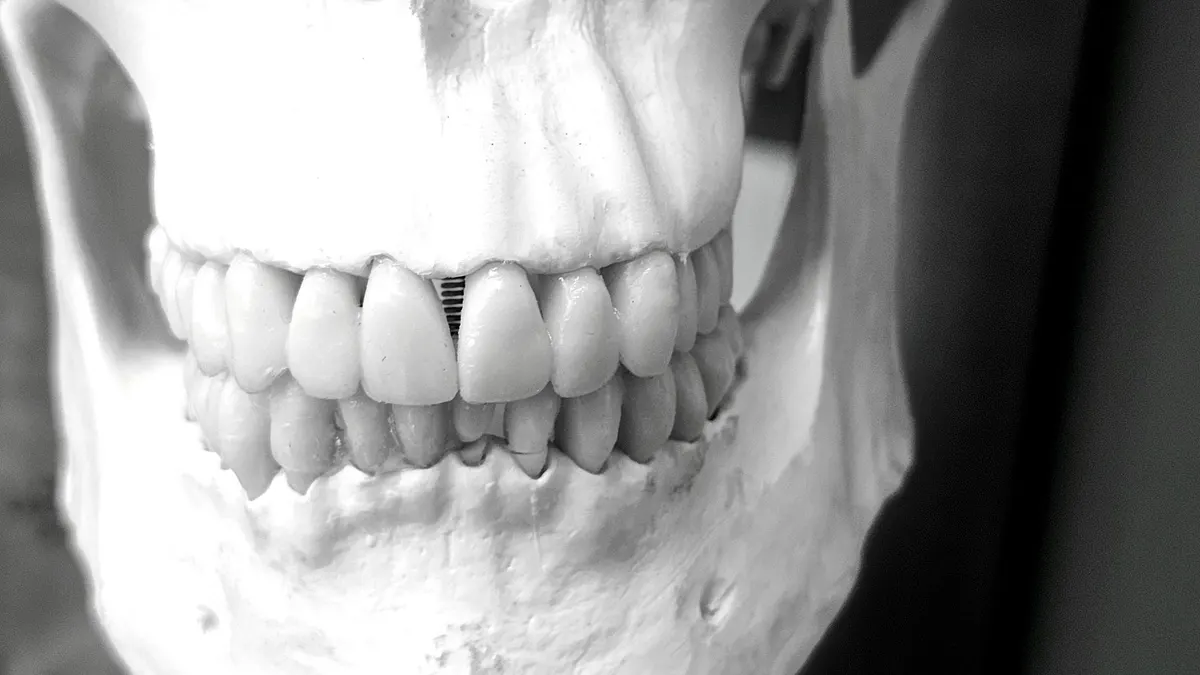 Najpierw implant czy aparat ortodontyczny? Decyzja w planie kompleksowym