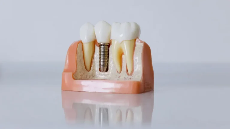 dental implant model closeup