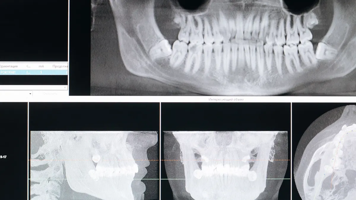 Ponowne badanie CBCT – kiedy klinika może nie wykorzystać wcześniejszej tomografii