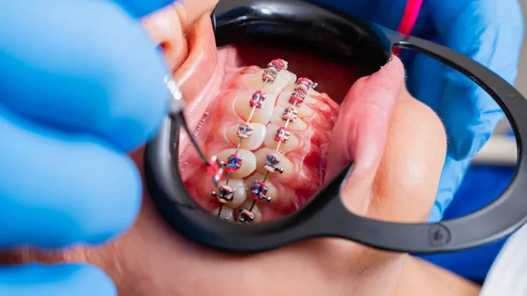 orthodontic braces aligner teeth