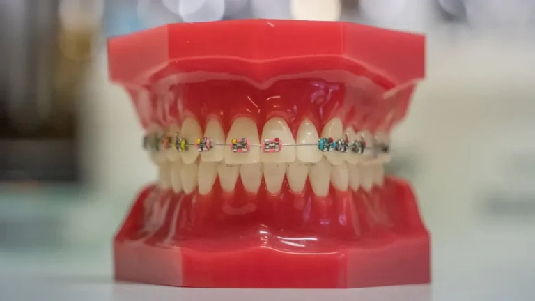 orthodontic braces aligner teeth