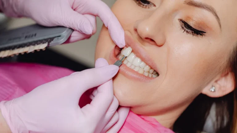 dental veneers smile makeover